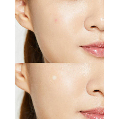 Acne Pimple Master Patch